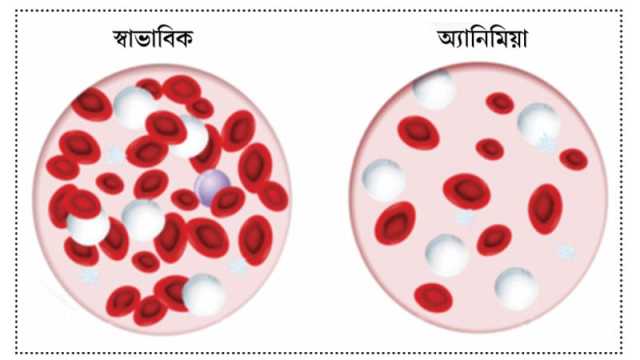 রক্তশূন্যতা কেন হয়?