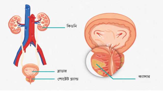 প্রস্টেট ক্যান্সার